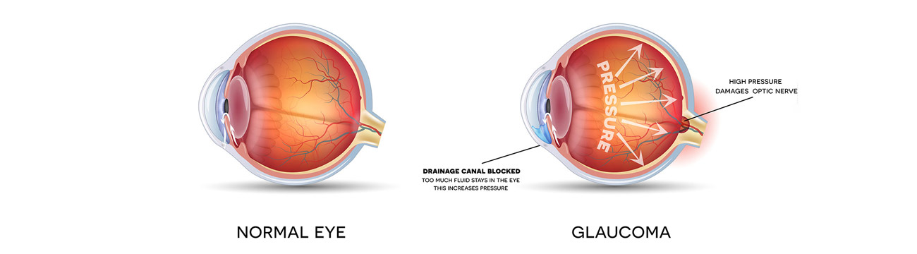 glaucoma anatomy